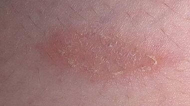 conas agus cad é psoriasis a chóireáil
