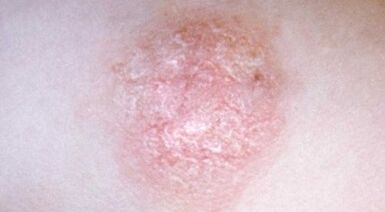 conas psoriasis a aithint ag céim luath