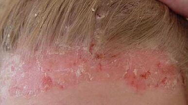 céimeanna forbartha agus comharthaí psoriasis