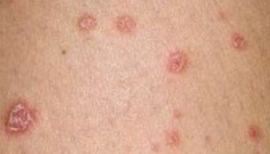 grianghraf de psoriasis sa chéad chéim