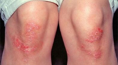 príomh-léirithe psoriasis
