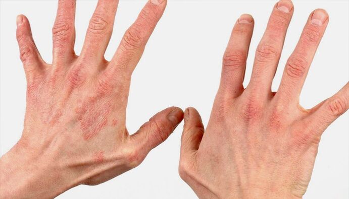 Modhanna chun psoriasis a chóireáil le leigheasanna tíre