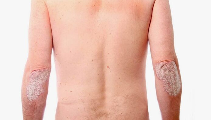 leigheasanna tíre le haghaidh cóireáil psoriasis