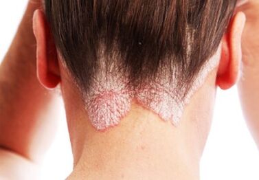 Psoriasis ar an gceann