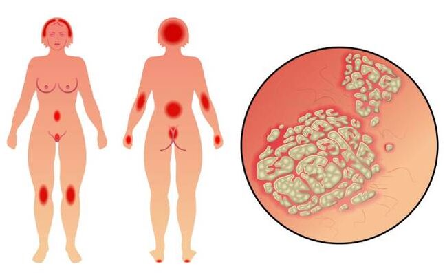 Comharthaí psoriasis