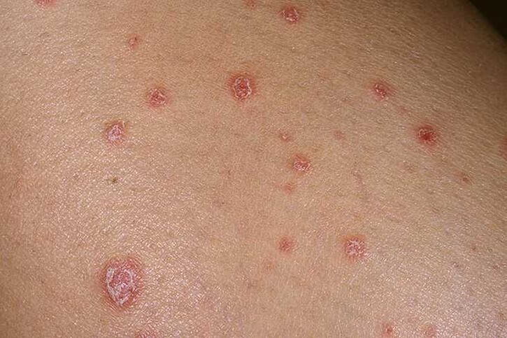Cúiseanna psoriasis