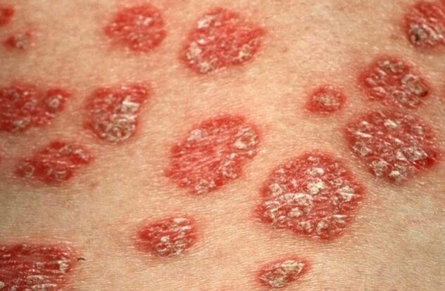 Papules psiatrach