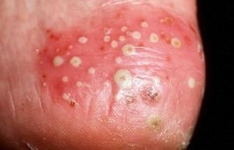 Tá psoriasis pustular