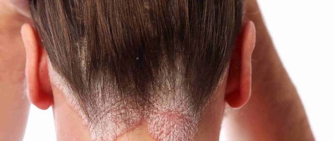 Psoriasis an chinn