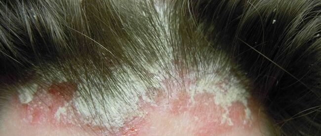 Psoriasis ar an gceann