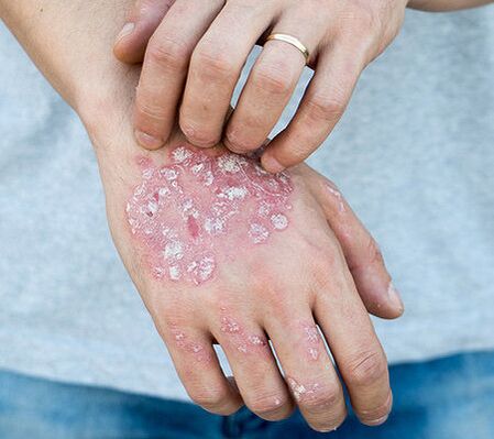 Psoriasis ar an lámh