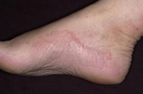 Psoriasis na coise