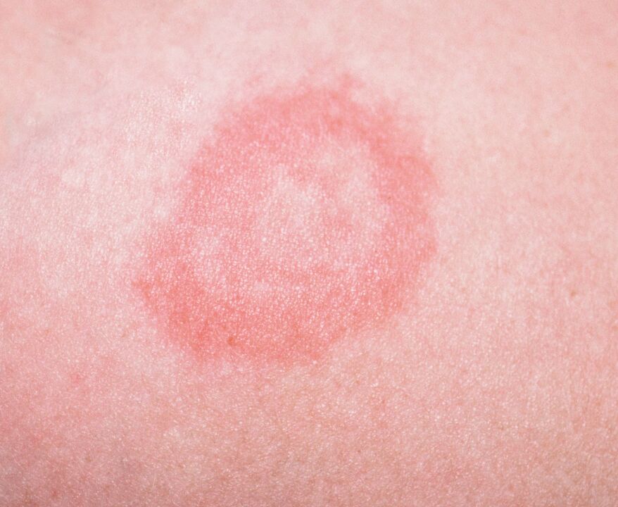 Tá psoriasis