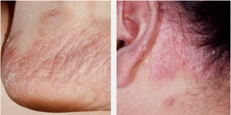 Cineálacha psoriasis