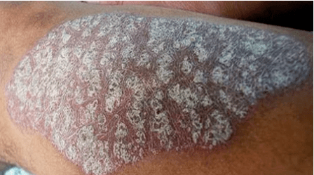 Pathogenesis de psoriasis