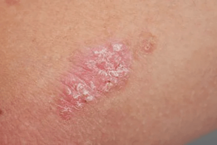 Psoriasis - An Chéim Tosaigh