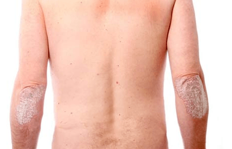 Comharthaí ginearálta psoriasis