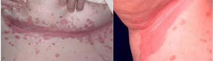 Foirm neamhghnách psoriasis
