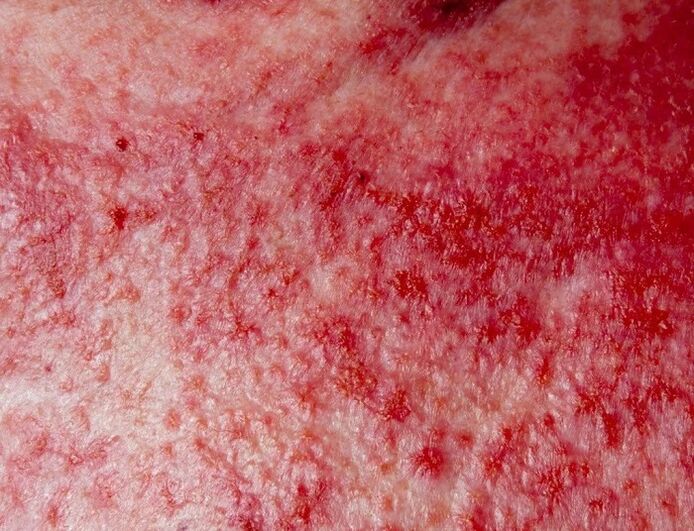 Foirm chun cinn psoriasis