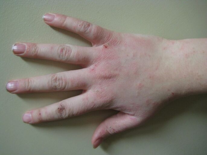 Psoriasis ag céim luath