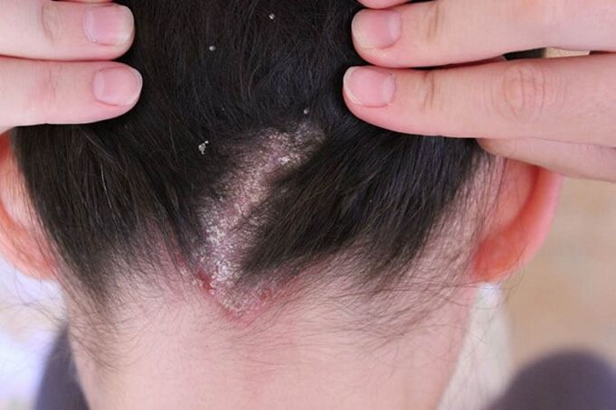 Psoriasis ar an ceann