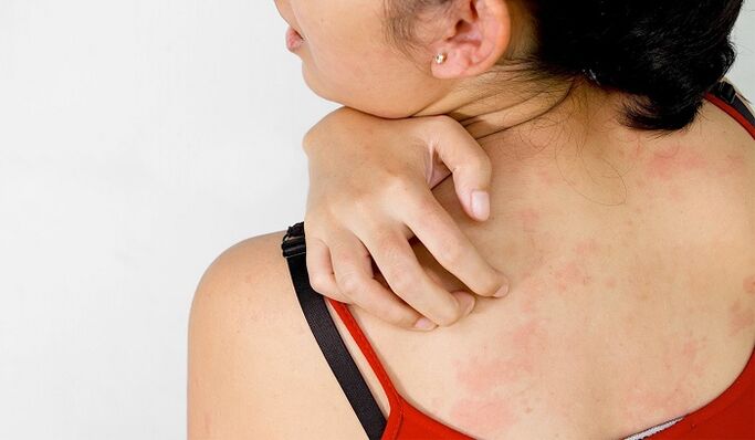 Psoriasis ar chúl