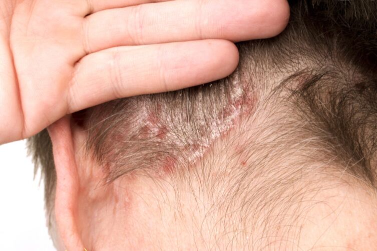 Exacerbation psoriasis ar an ceann