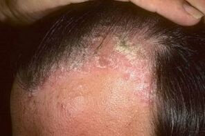 Posriasis ar an scalp