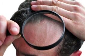 Psoriasis ar an ceann trí gloine formhéadúcháin