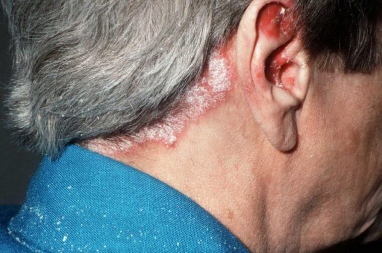 Psoriasis ar an ceann