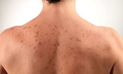cúiseanna le forbairt psoriasis