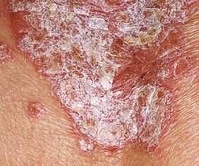 Céim stáiseanóireachta de psoriasis