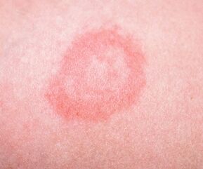 Céim tosaigh psoriasis
