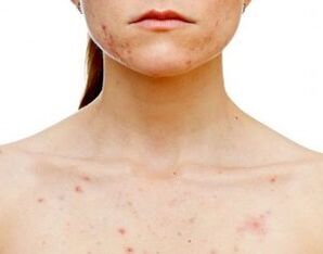 Cad iad na codanna den chorp a bhfuil psoriasis le feiceáil