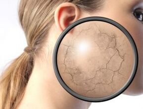 Conas a léirítear psoriasis