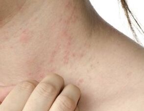 príomh-airíonna psoriasis