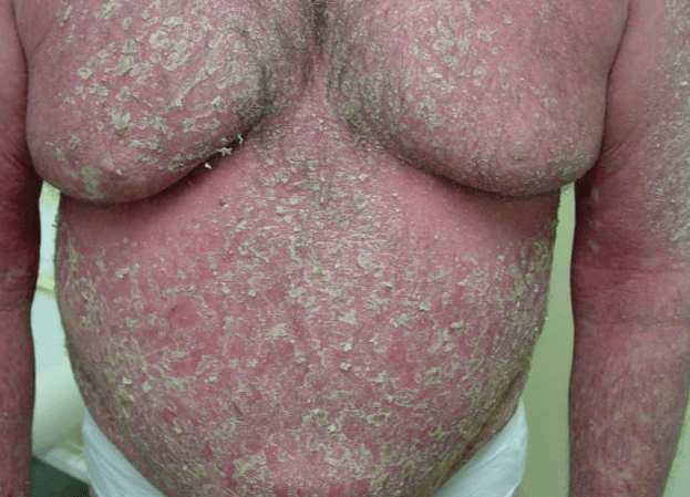 Erythroderma psoriatic ar an gcomhlacht