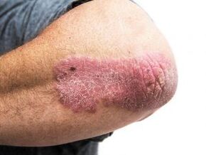 Psoriasis plaic ar an elbow