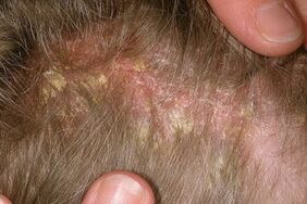 Psoriasis ar an gceann