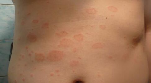 Psoriasis ar an gcorp