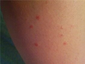 Psoriasis ar an gcraiceann