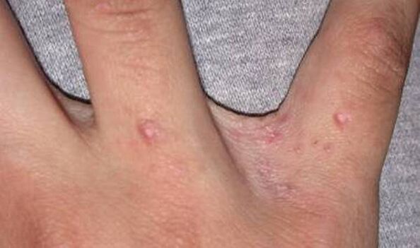 Tús an psoriasis